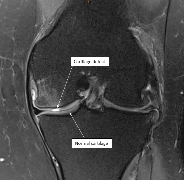 Cartilage defect