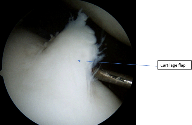 Cartilage Flap