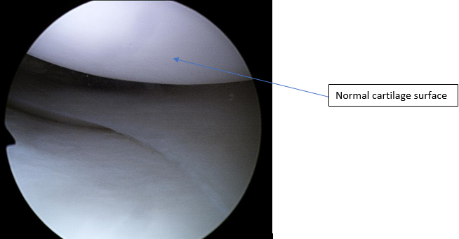 Cartilage surface