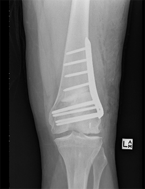 Distal femoral Osteotomy