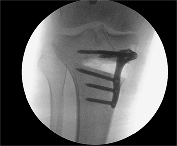 High Tibial Osteotomy