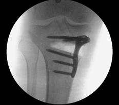 High Tibial Osteotomy