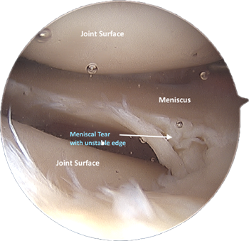 Meniscal Debridement surgery