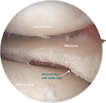 Meniscal Debridement surgery