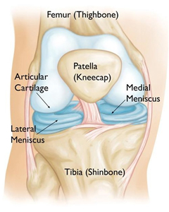 medial meniscus tear