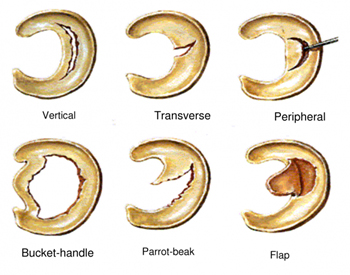 Meniscal Tears Types